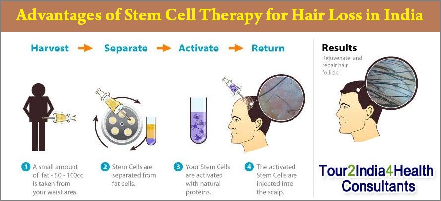 Advantages of Stem Cell Therapy for Hair Loss in India - Tour2India4Health  Blog