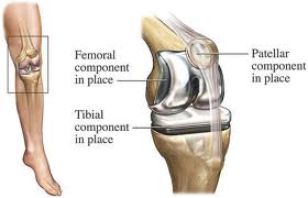 Arthroplasty Surgery in India