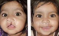 Benefits of Cleft-lip Surgery India
