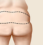 Butt Lift Surgery in India