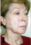 Neck Lift Surgery Benefits India