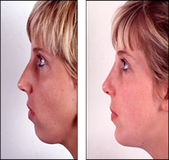 Chin Augmentation in India after
