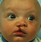 Low Cost Cleft-Lip Surgery India
