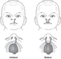 Cleft-lip Surgery in India