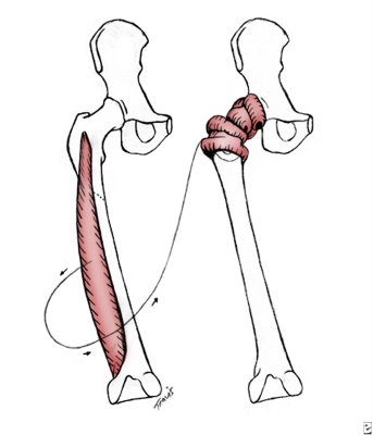 Girdlestone Surgery India