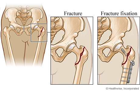 Internal Fixation India