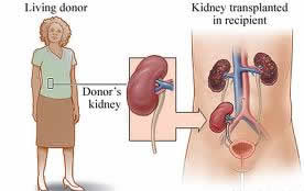Low Cost Kidney Surgery in India