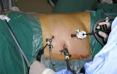 Kidney Transplant Benefits India