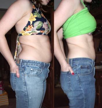 Liposuction Surgery India