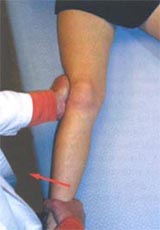 ligament types, ligament injury causes, ligament injury symptoms