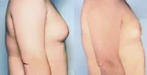 male breast reduction surgery India