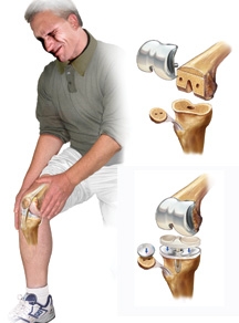 benefits total knee replacement India