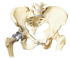 Hip Replacement Surgery