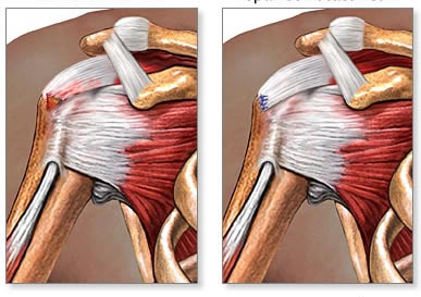Rotator Cuff Tear Diagnosis India
