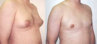 cost breast reduction surgery India