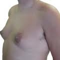 cost male breast reduction surgery India