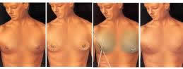 low cost breast reduction surgery India