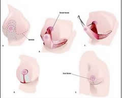 low cost breast reduction surgery India