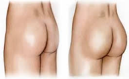 cost buttock augmentation surgery India