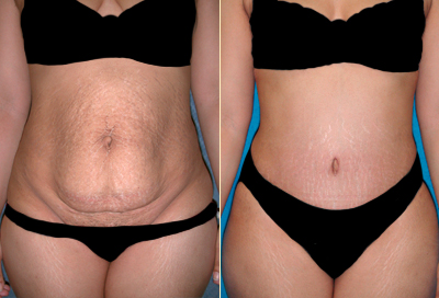 Tummy Tuck surgery India