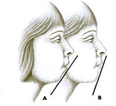 Why Chin Implant Surgery