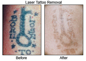 Laser Tattoo Removal System India,Cost Laser Tattoo ...