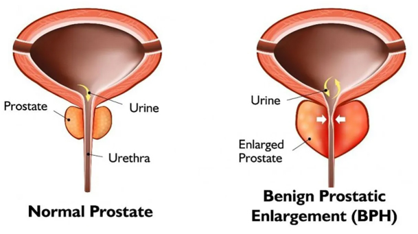 Treat Enlarge Prostate Cancer