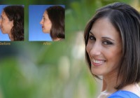 Rhinoplasty Surgery in India