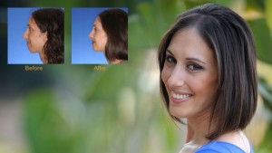 Rhinoplasty Surgery in India