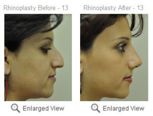 Rhinoplasty Surgery in India