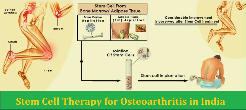 Stem Cell Therapy for Osteoarthritis in India Stem Cell Therapy for Osteoarthritis in India