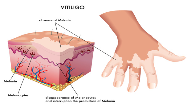 Causes of vitiligo Causes of vitiligo