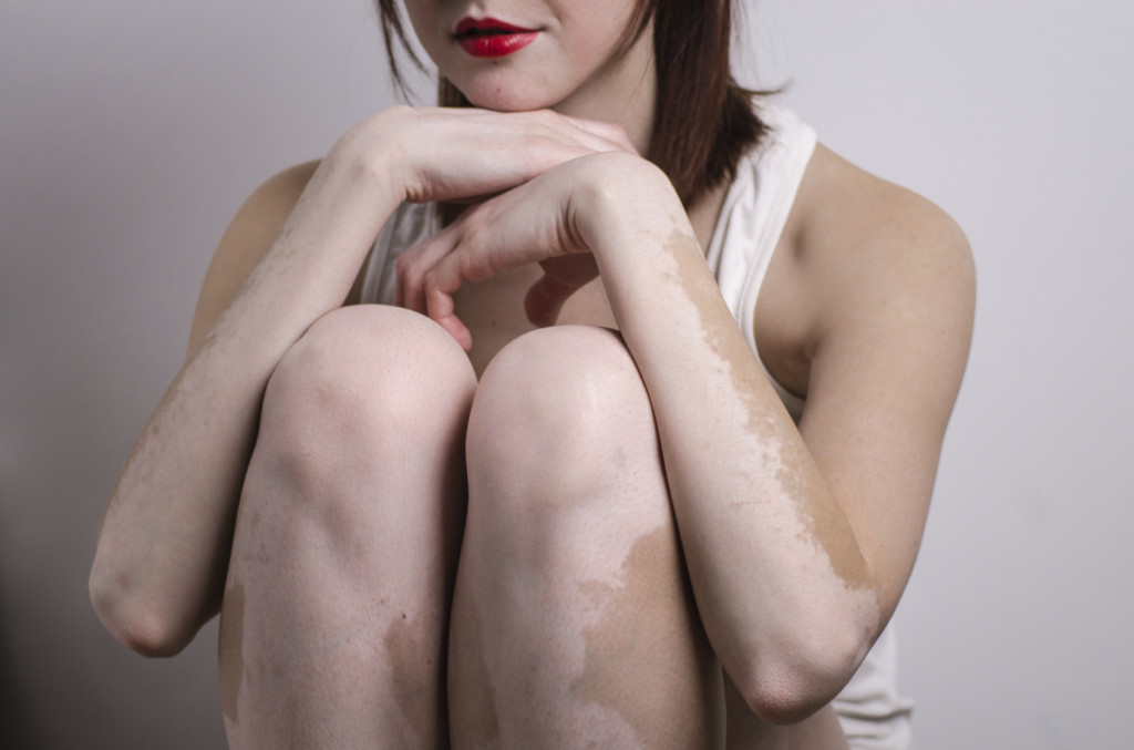 Symptoms of vitiligo symptoms-of-vitige
