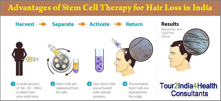 Advantages of Stem Cell Therapy for Hair Loss in India with Tour2India4Health Stem Cell Therapy for Hair Loss in India, Cost Stem Cell Therapy for Hair Loss in India, Stem Cell Therapy for Hair Loss India, Price of Stem Cell Therapy for Hair Loss in India, Best Clinic Stem Cell Therapy for Hair Loss in India, Stem Cell Therapy for Hair Loss in Mumbai, Stem Cell Therapy for Hair Loss in Delhi, Stem Cell Therapy for Hair Loss in Goa, Best Stem Cell Therapy for Hair Loss in India, Stem Cell Therapy for Hair Loss,