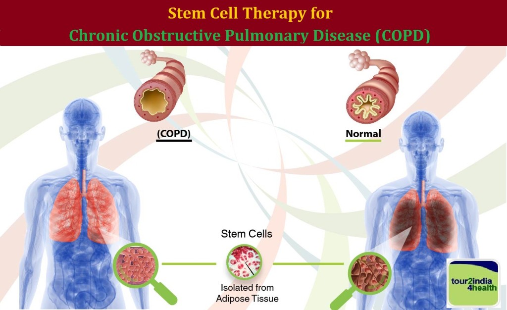Stem Cell Therapy for Chronic Obstructive Pulmonary Disease, Cost Stem Cell Therapy for Chronic Obstructive Pulmonary Disease in India, Stem Cell Therapy for COPD India, Low cost Stem Cell Therapy for Chronic Obstructive Pulmonary Disease in India, Stem Cell Therapy for Chronic Obstructive Pulmonary Disease cost India, Best Stem Cell Therapy for Chronic Obstructive Pulmonary Disease India, Stem Cell Therapy for Chronic Obstructive Pulmonary Disease Delhi,Mumbai, Bangalore, India, Stem Cell Therapy India, Cost of Stem Cell Therapy, Low cost Stem Cell Therapy