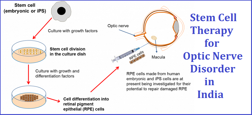 stem cell hospital india, stem cell therapy for glaucoma in india, stem cell therapy for optic nerve atrophy, stem cell optic nerve repair, stem cell therapy for eyes in india, stem cell therapy for optic nerve cost in India, stem cell therapy for optic nerve in India, cost of stem cell therapy for optic nerve India, low cost of stem cell therapy for optic nerve India, stem cell therapy for optic nerve,