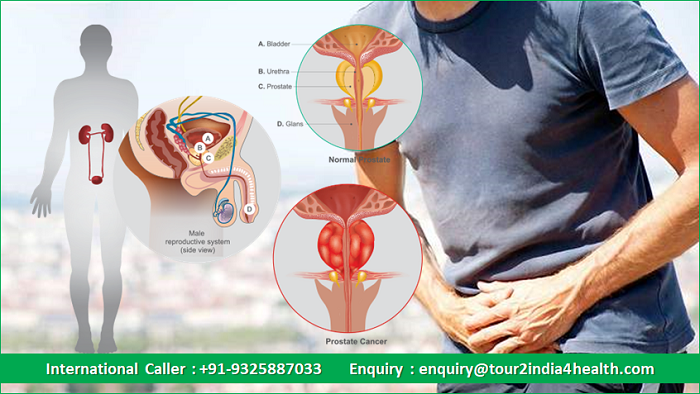 Radical Prostatectomy In India, cost of radical prostatectomy in india, radical prostatectomy in india cost, radical prostatectomy cost india, Radical Prostatectomy Success rates in India, successful Radical Prostatectomy in India, Success story of Radical Prostatectomy in India, cost of robotic radical prostatectomy in india, cost of radiation prostatectomy in india, average cost of radical prostatectomy in india, radical prostatectomy hospital in bangalore, radical prostatectomy surgeons in delhi,