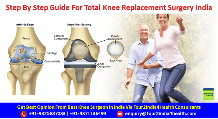 Total Knee Replacement Surgery, Total Knee Replacement Procedure India, Success rate of Total Knee Replacement India, Symptoms Of Total Knee Replacement Surgery, Signs Of Total Knee Replacement Surgery, Knee Replacement Implant India, Total Knee Replacement Surgery India, Step-By-Step Guide For Total Knee Surgery, benefits Total Knee Replacement surgery India, cost of Total Knee Replacement Surgery India,