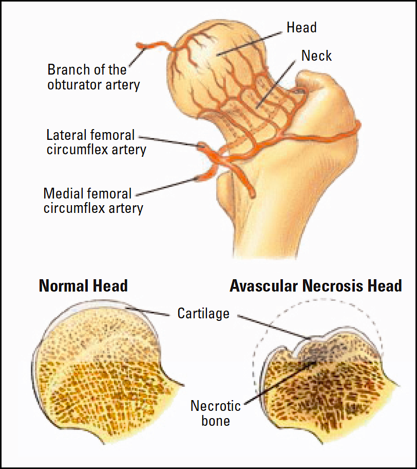 avascular necrosis hip replacement surgery recovery, avascular necrosis after hip replacement, avascular necrosis surgery in India, how cost of avascular necrosis, avascular necrosis post hip replacement, avascular necrosis stage 3 treatment, total hip replacement avascular necrosis, avascular necrosis of hip, hip replacement for avascular necrosis, hip replacement avascular necrosis Delhi, Cost of hip replacement avascular necrosis Mumbai, Affordable hip replacement avascular necrosis surgery in Bangalore, Survival Rate Of Avascular Necrosis Surgery in India