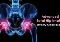 Total Hip Implant Surgery India, Advanced Total Hip Replacement Implant India, Cost of Total Hip Surgery Implant India, Total Hip Replacement Implant cost India, Best Hip joint Replacement Surgery India, Total Hip Replacement Surgery cost India, Dr. Vijay C. Bose Hip Implant specialist Apollo, Dr. Vijay C. Bose Hip Implant Surgeon India, Best Hospitals For Total Hip Implant Surgery in India, Total Hip Implant Hospitals in India,