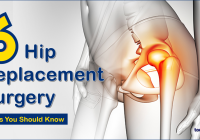 Hip-Replacement-Surgery
