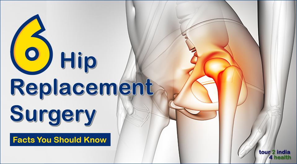 6 Hip Replacement Surgery Facts You Should Know