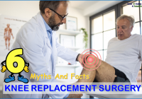 knee replacement surgery