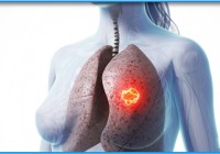 Stem Cell Therapy for Chronic Obstructive Pulmonary Disease in India