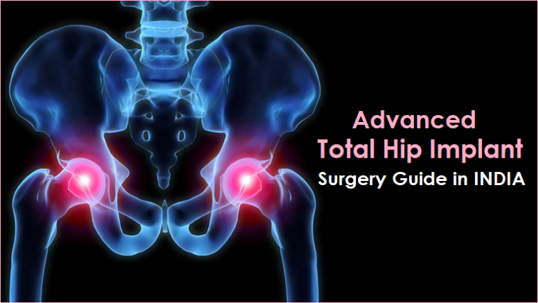 Advanced Total Hip Replacement Implant India : Surgery Guide ...