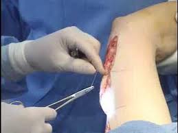 Brachioplasty Surgery Procedure