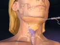Chin Augmentation surgery india