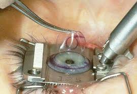 Eye Surgery in India
