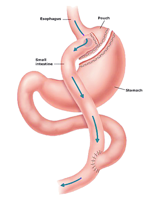 Gastric bypass  surgery India