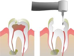 Root Canal Therapy india